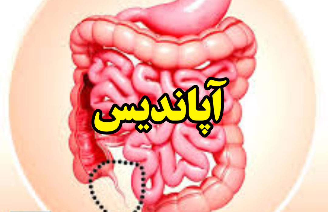 آپاندیس