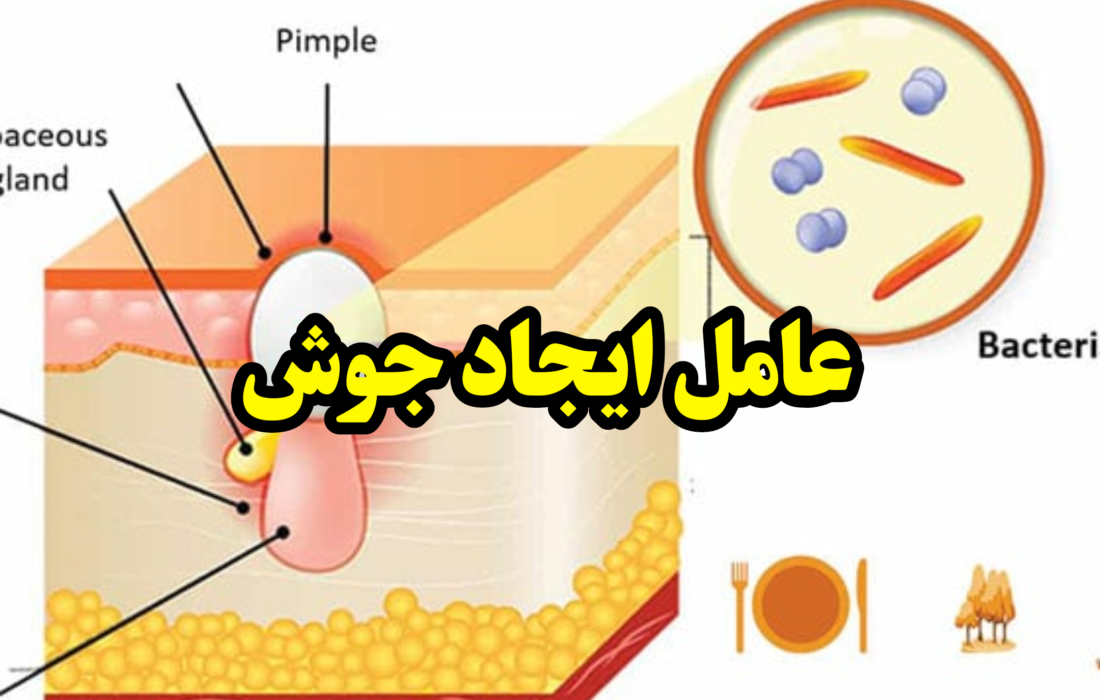 دلیل ایجاد جوش و آکنه چیست؟!