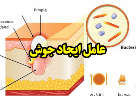 دلیل ایجاد جوش و آکنه چیست؟!